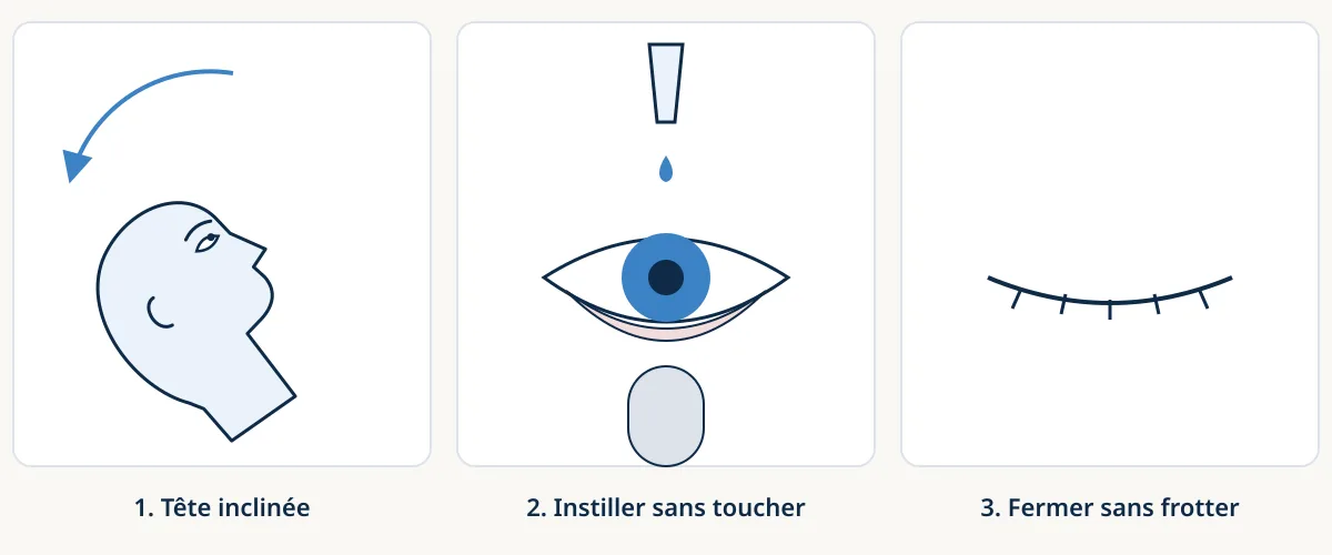 Schéma en trois vignettes pour bien mettre son collyre : tête inclinée en arrière, paupière inférieure tirée doucement et goutte instillée sans toucher l’œil, puis œil fermé sans frotter.