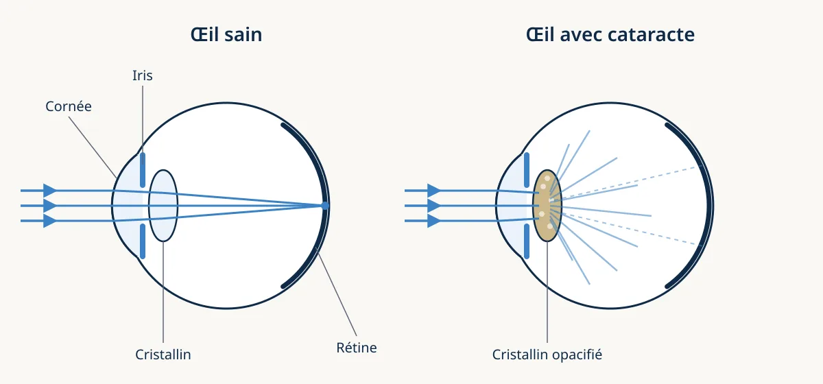 Schéma d’un œil sain, où le cristallin transparent fait converger la lumière sur la rétine, et d’un œil avec cataracte, où le cristallin opacifié diffuse la lumière.