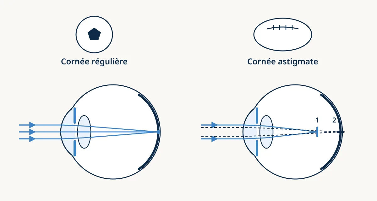 Schéma comparant une cornée régulière, comme un ballon de football, avec un point focal unique, et une cornée astigmate, comme un ballon de rugby, avec deux lignes focales.
