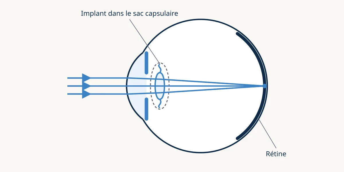Schéma de l’œil après opération de la cataracte : l’implant, placé dans le sac capsulaire, remplace le cristallin et fait converger la lumière sur la rétine.