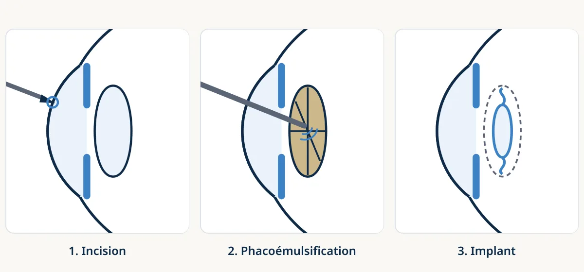 Schéma de l’opération de la cataracte en trois étapes : petite incision de la cornée, fragmentation et aspiration du cristallin par ultrasons, implant placé dans le sac capsulaire.