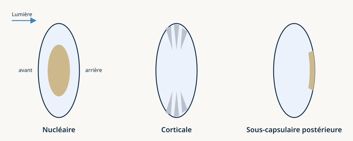 Schéma du cristallin vu de profil montrant trois types de cataracte : nucléaire au centre, corticale en rayons à la périphérie, sous-capsulaire postérieure à l’arrière.